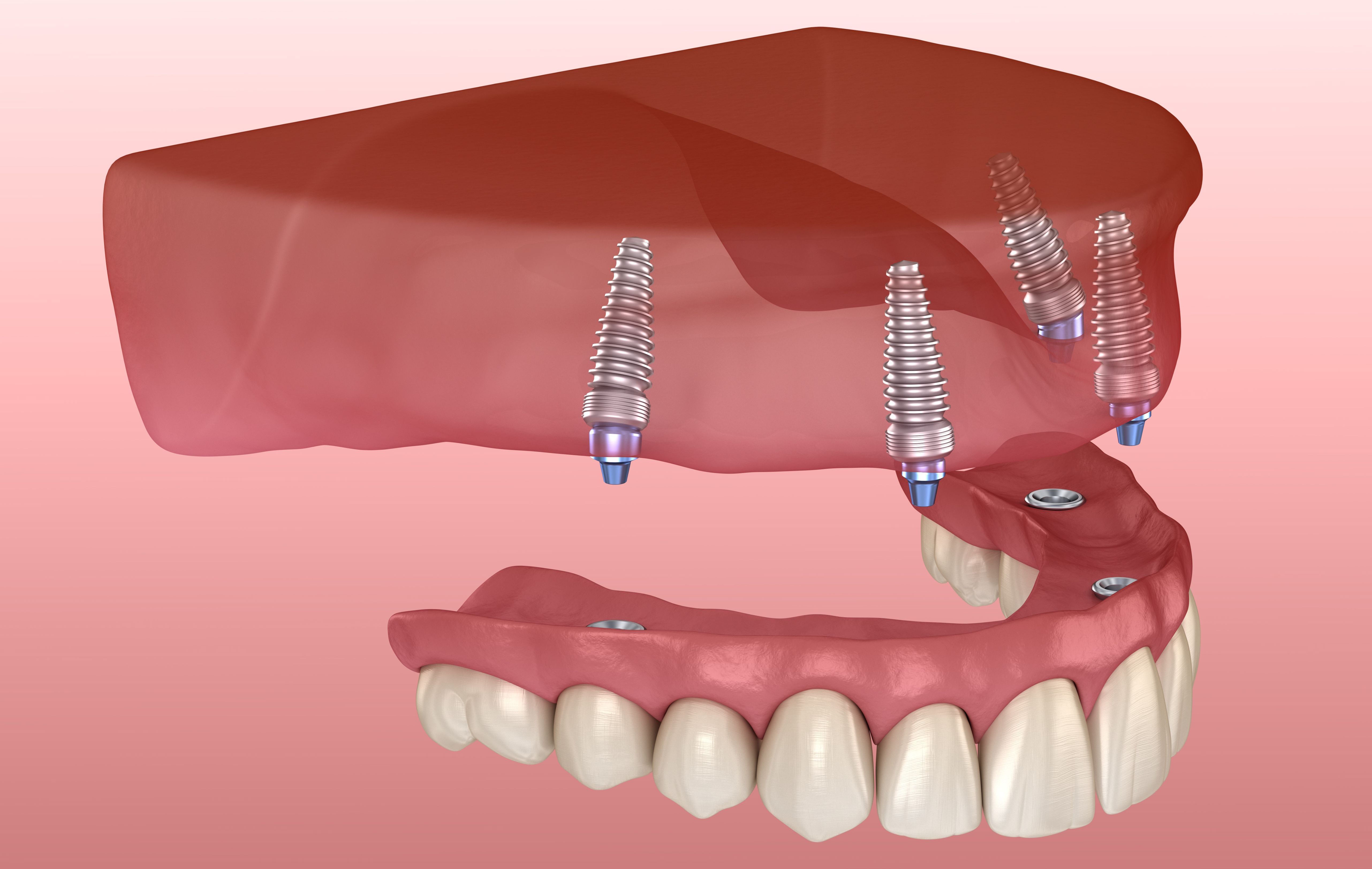 prótesis dental fija